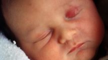 hemangiome infantile